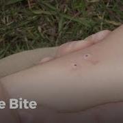 Learn First Aid Gestures Snake Bite