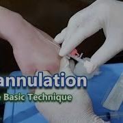 IV Cannulation Learn The Basic Technique IV Cannula
