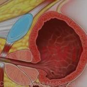 TURBT Transurethral Resection Of Bladder Tumor Male PreOp Patient Education