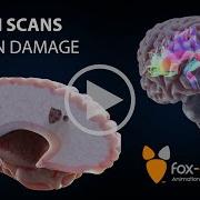 Brain Damage On DTI Scans