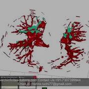 Implementation Of 3D Lungs Segmentation In Matlab 91 8283824812 For Any Related Query
