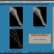 Bone Fracture Detection Using Image Processing With Source Code Matlab Project Fracture Detect