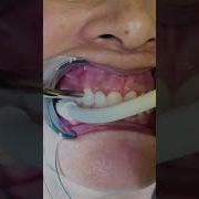Applying Desensitizing Paste On Roots To Minimize Teeth Sensitivity In Office To Hands On Dental