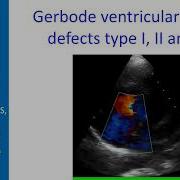 Gerbode Ventricular Septal Defects Type I II And III
