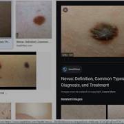 Skin Cancer Classification Using Deep Neural Networks DEMO