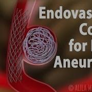 Endovascular Coiling For Brain Aneurysm Animation