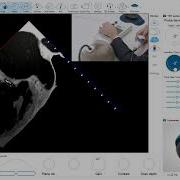 TEE Assessment Left Atrial Appendage Important Tips