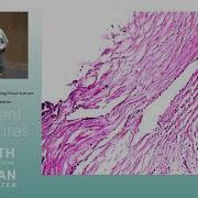 Glaucoma Pathology ARCHIVE