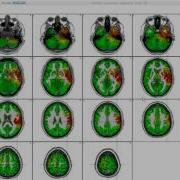 Preview Of SwLORETA Video Upper Lower Cortical Surfaces