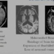 Eating Disorders Acute And Chronic Health Impacts Part 2 Of 2
