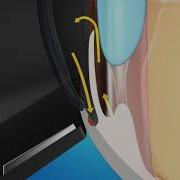 What Happens During Laser Trabeculopasty Surgery