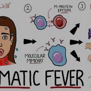 Rheumatic Fever Made Easy Including Jones Criteria And Mnemonic