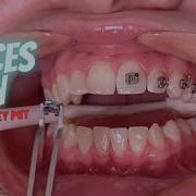 How Do They Put Braces On Tooth Time Family Dentistry New Braunfels