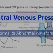 Central Venous Pressure CVP Waveforms