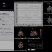 EEG Source Imaging Of Epilepsy Recordings Using Brainstorm
