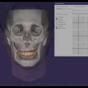 Seamless Workflow RAYFace To Exocad Integration With Dynamic Occlusion