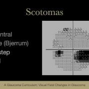 7 EXAMINATION Visual Field Changes In Glaucoma