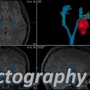 Diffusion Tensor Imaging EXPLAINED DTI FA Tractography MRI Physics Course Lecture 15