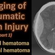 Imaging Of Traumatic Brain Injury Epidural And Subdural Hematoma