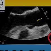 Side Lobe Artifacts