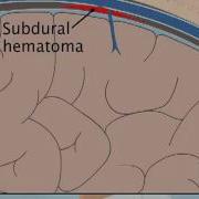 Understanding Subdural Hematoma