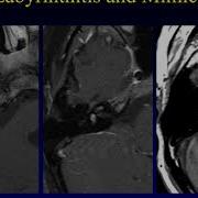 Temporal Bone Pathology 6 Hearing Loss Part 1