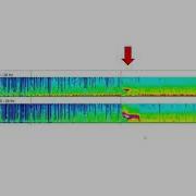 Quantitative EEG Color Density Spectral Array CDSA