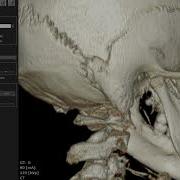 OnDemand 3D Ceph Asymmetry