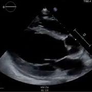 Acquired Gerbode Defect In A Patient With Infective Endocarditis Of Bicuspid Aortic Valve
