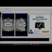 Blue Sky Plan Ceph Module CBCT Vs Ceph Arm