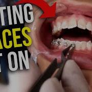 How BRACES Are Put On Step By Step Process