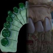 Wax Up Примеры воскового моделирования