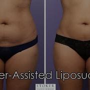 Liposuction Los Angeles Plastic Surgeon Dr David Stoker Explains 360 Degree Body Contouring