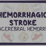 Hemorrhagic Stroke Intracerebral Hemorrhage Causes Symptoms Diagnosis Treatment Pathology