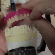 Complete Maxillary Denture Against Lower Natural Dentition Class II Division II
