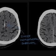 Understanding The Different Types Of Traumatic Brain Bleed On CT Scans