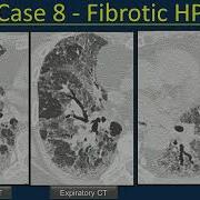 Case Based Hypersensitivity Pneumonitis