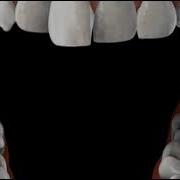 Braces Self Ligating