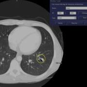 Window Width Window Level W L Concepts CT Thorax Example
