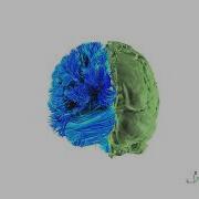 Whole Brain Tractography Using 128 Diffusion Directions HyperBand DTI