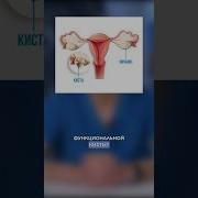 Ни в коем случае не делайте это если у вас киста яичника гинекология