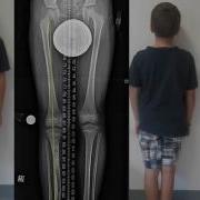 Fixing Congenital Leg Length Discrepancy In Children