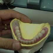 Lingualized Occlusion