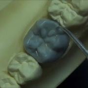 Live Wax Up Lower 1st Molar Wax Up Full