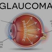 What Is Glaucoma Animated Video