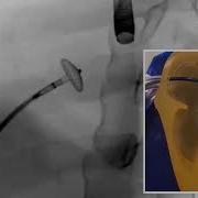 How It Works Transcatheter Closure Of Atrial Septal Defect ASD