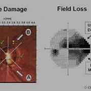 Glaucoma 1 Diagnosis