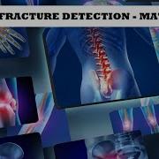 Bone Fracture Detection Using CNN MATLAB Image Processing Matlab Deeplearning