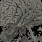 3D VRT MRI Of Brain And Face