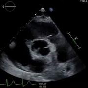Acquired Gerbode Defect In A Patient With Infective Endocarditis Of Bicuspid Aortic Valve